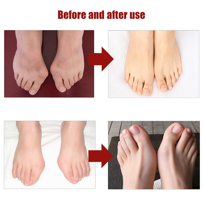 Bye Joanete™ – Alívio imediato e proteção diária 👣